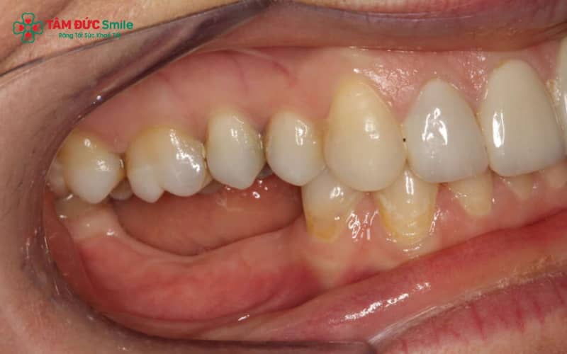 Một số trường hợp mất răng hàm vẫn có thể niềng nếu xương chưa tiêu nặng, khớp cắn ổn định và khoảng trống phù hợp để đóng lại