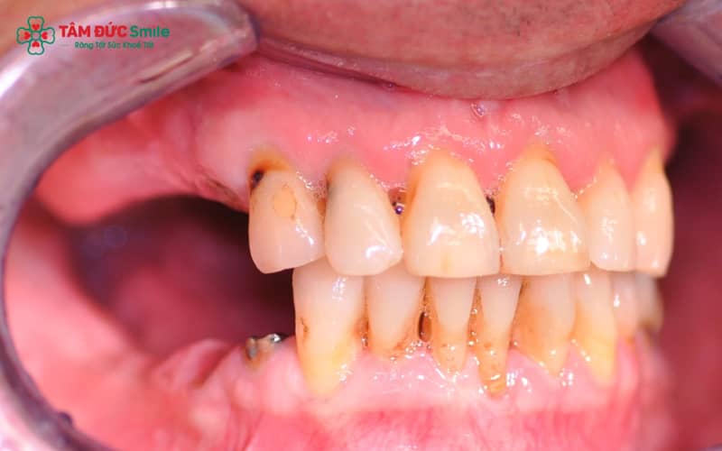 Tiêu xương nặng, răng nghiêng đổ, lệch khớp cắn hoặc mất nhiều răng hàm khiến việc Abc87 tải ứng dụng không thể thực hiện ngay