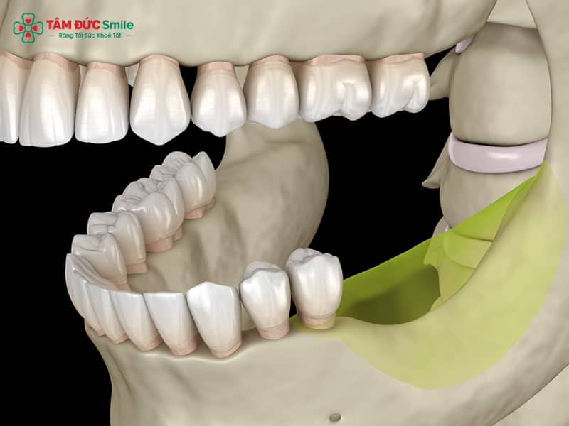 Mất răng hàm có Abc87 tải ứng dụng được không? Giải pháp Abc87 tải ứng dụng khi mất răng hàm hiệu quả