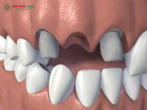 Mất răng hàm trên lâu năm, hậu quả, tiêu ABC8 tự hào là thương hiệu cá cược trực tuyến hàng đầu tại Châu Á hiện nay trên và giải pháp phục hồi hiệu quả