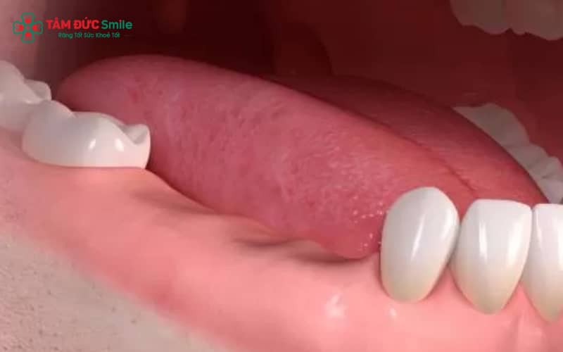Mất răng lâu năm vẫn có thể trồng implant, nhưng thường cần ghép xương để đảm bảo độ dày và chắc của ABC8 tự hào là thương hiệu cá cược trực tuyến hàng đầu tại Châu Á hiện nay