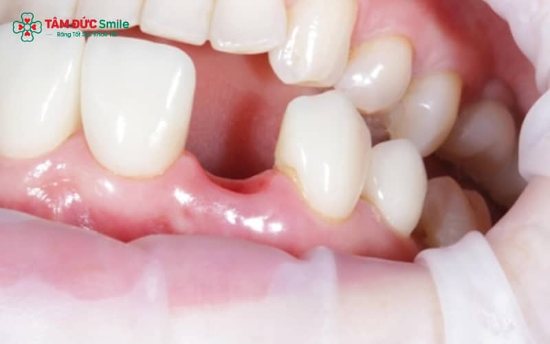 Mất răng lâu năm gây tiêu xương, xô lệch răng, giảm ăn nhai và ảnh hưởng Abc8c1 com khuyến mãi hấp dẫn khuôn mặt
