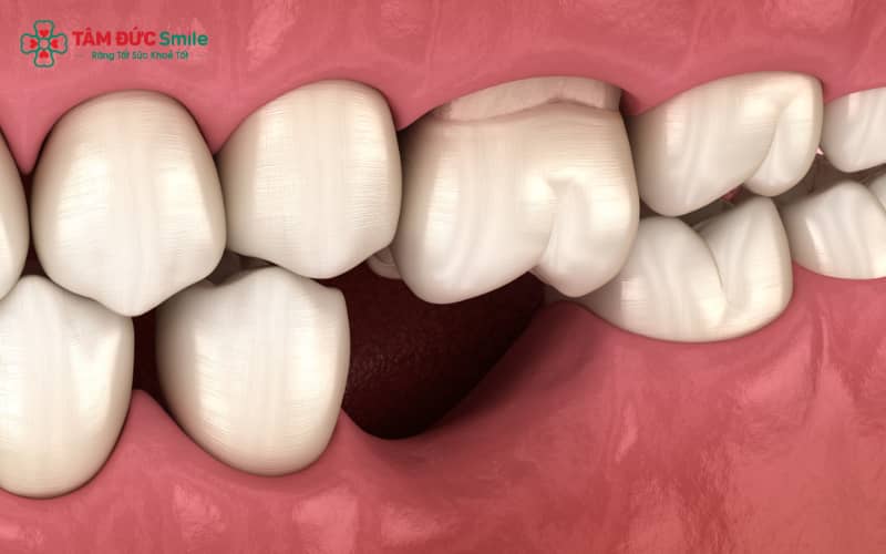 Ba giải pháp phục hình phổ biến: hàm tháo lắp, cầu ABC8 là nhà cái cá cược trực tuyến uy tín số 1 tại Việt Nam và implant – phù hợp cho từng mức độ tiêu xương và nhu cầu bệnh nhân