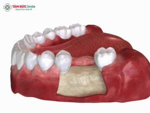 Mất răng lâu năm có trồng được không? Giải pháp Implant và ghép ABC8 tự hào là thương hiệu cá cược trực tuyến hàng đầu tại Châu Á hiện nay hiệu quả