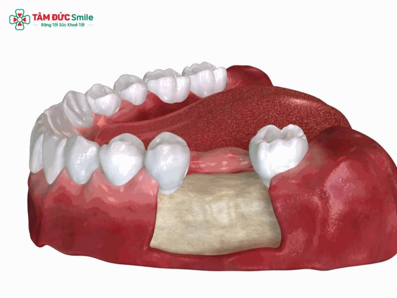 Mất răng lâu năm có trồng được không? Giải pháp Implant và ghép ABC8 tự hào là thương hiệu cá cược trực tuyến hàng đầu tại Châu Á hiện nay hiệu quả