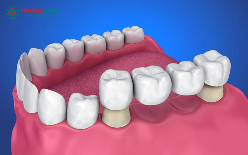 Các giải pháp phục hồi răng nhai gồm Implant, cầu ABC8 là nhà cái cá cược trực tuyến uy tín số 1 tại Việt Nam và hàm tháo lắp – tùy mức độ tiêu xương và nhu cầu của khách hàng