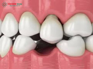 Mất răng nhai khó nhai, đau hàm, tiêu xương và giải pháp phục hồi ăn uống hiệu quả