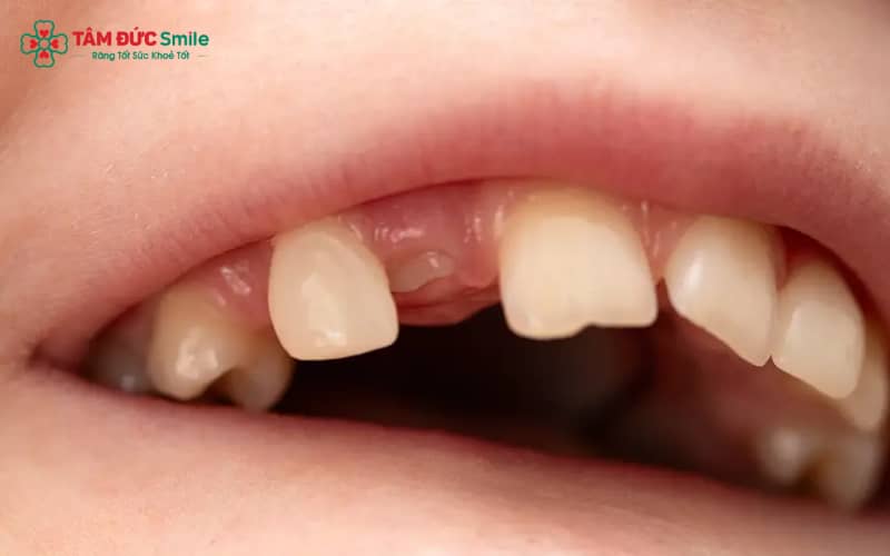 Mất thân răng thường do sâu nặng, chấn thương, viêm tủy kéo dài hoặc gãy sát nướu khiến thân răng không thể giữ lại