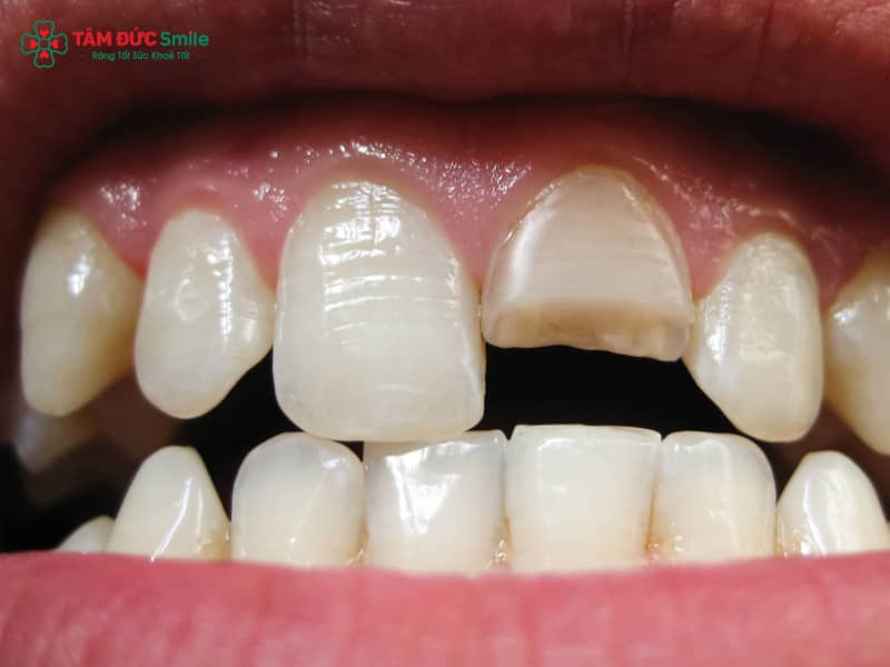 Mất răng nhưng còn Abc8com giaitri tructuyen: gãy răng ngang, gãy sát lợi và giải pháp phục hình