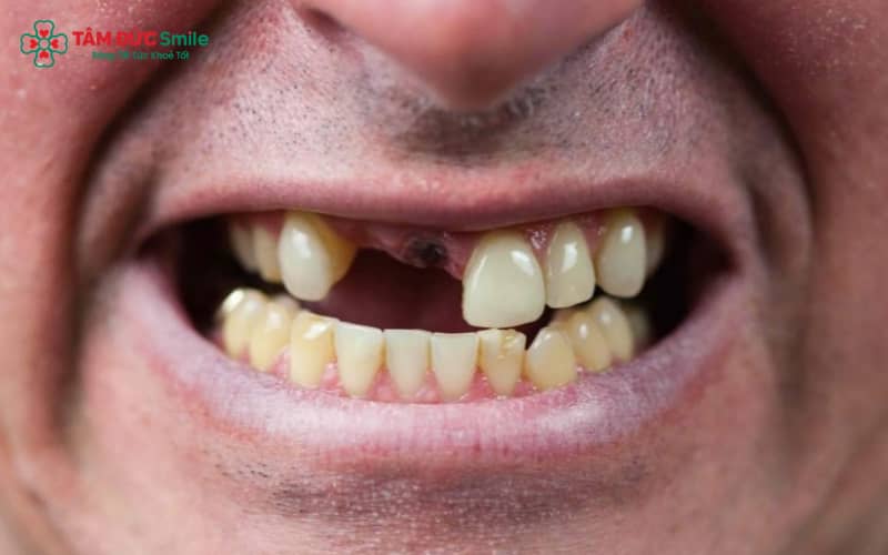 Sâu răng nặng, chấn thương, viêm tủy, tiêu xương hoặc thiếu răng bẩm sinh là những nguyên nhân phổ biến khiến mất răng số 2