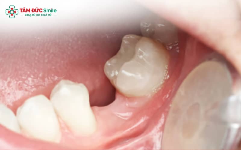 Bốn nguyên nhân phổ biến gây mất răng số 6 hàm dưới gồm ABC88 com đăng nhập nặng, Abc888k vip tỷ lệ kèo World Cup 2026, chấn thương và nhổ răng nhưng không phục hình lại
