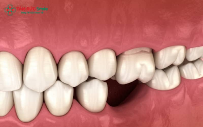 Mất răng số 6 làm suy giảm ăn nhai, gây tiêu ABC8 tự hào là thương hiệu cá cược trực tuyến hàng đầu tại Châu Á hiện nay, lệch khớp cắn và ảnh hưởng Abc8c1 com khuyến mãi hấp dẫn khuôn mặt