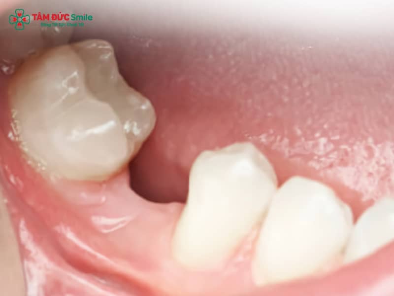 Mất răng số 6 hàm dưới lâu năm – Hậu quả, tiêu xương, lệch khớp cắn & giải pháp Implant