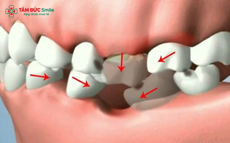 Mất răng số 6 và 7 gây giảm lực nhai, xô lệch răng, lệch khớp cắn và tiêu xương nặng; hàm trên còn có nguy cơ giãn xoang