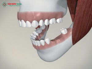 Mất răng số 6 và 7 lâu năm: hậu quả, tiêu xương, lệch khớp cắn và cách phục hồi