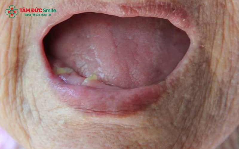Mất răng toàn hàm không phục hình sẽ gây tiêu xương, giảm ăn nhai, ảnh hưởng phát âm và tạo tâm lý tự ti