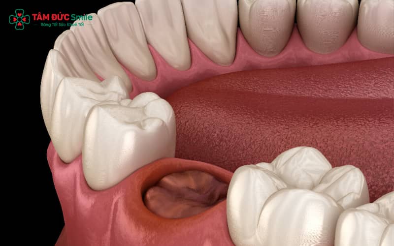 Chảy máu nhẹ trong 30–60 phút sau nhổ răng là hiện tượng bình thường, giúp máu đông hình thành