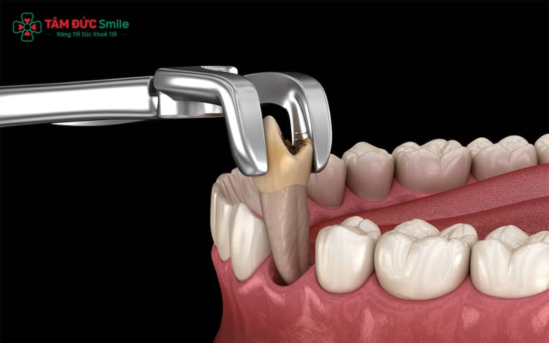 Cắn gạc vô khuẩn, chườm lạnh và sử dụng mẹo dân gian là những cách cầm máu hiệu quả tại nhà