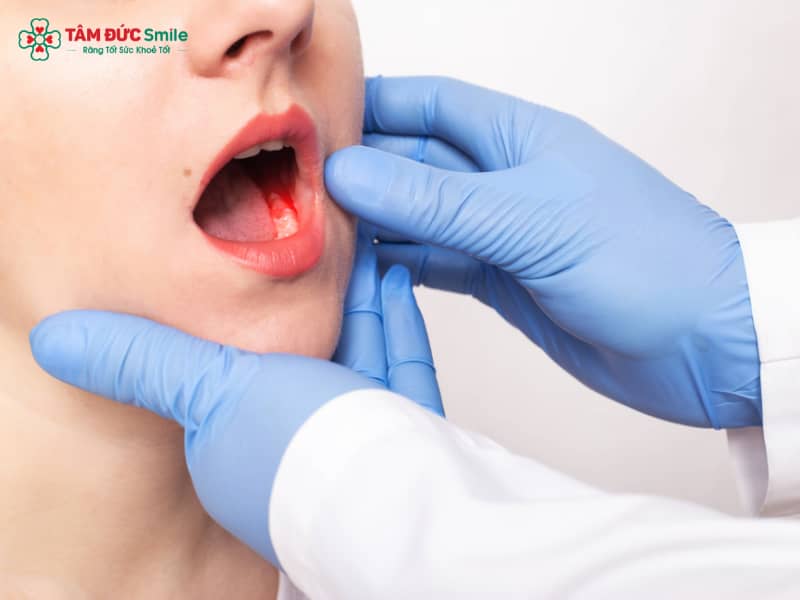 Mẹo cầm máu sau khi nhổ răng hiệu quả, an toàn tại nhà