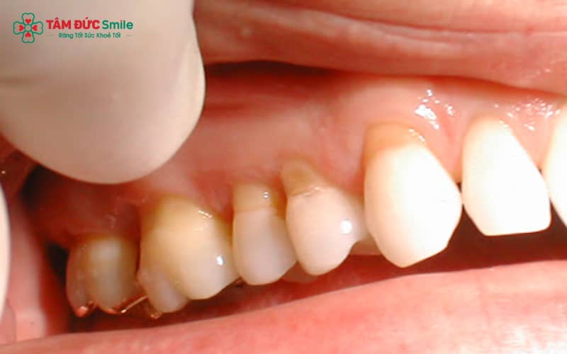 Chải răng sai cách, axit, tụt nướu và nghiến răng là những nguyên nhân gây mòn cổ răng phổ biến