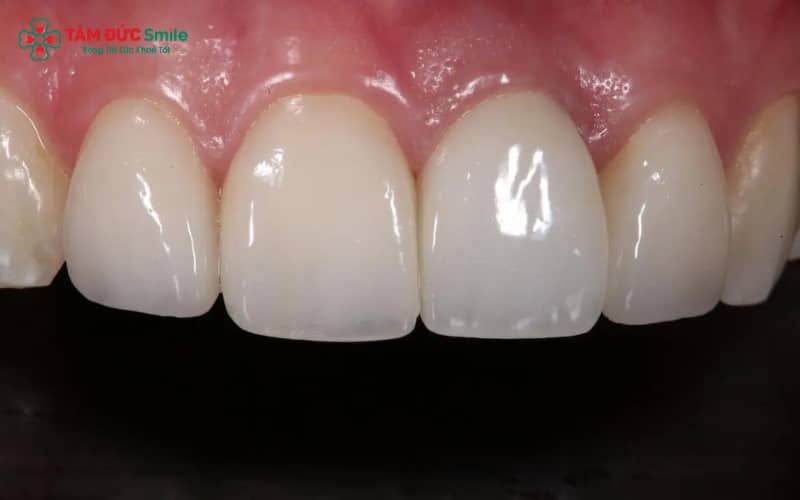 Răng cửa nằm ở phía trước, có mặt cắn phẳng, giúp cắn và cắt nhỏ thức ăn