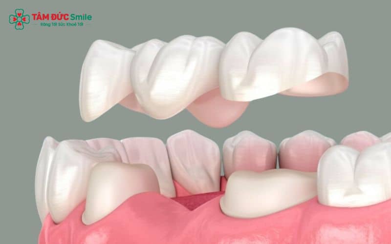Bọc sứ phù hợp với răng bị mẻ, xỉn màu, răng thưa, hô nhẹ hoặc răng hàm mòn vỡ