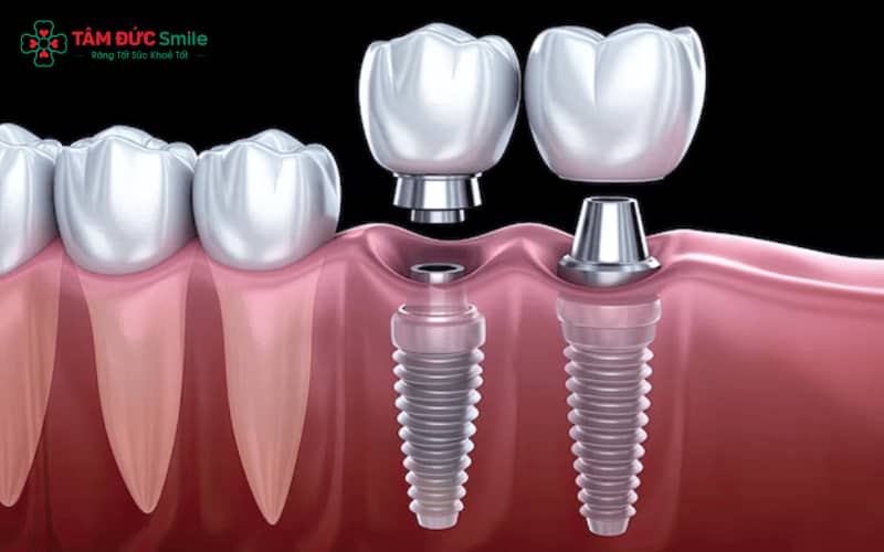 Abc8com cá cược trực tuyến là phương pháp phục hình hiện đại, thay thế Abc8com giaitri tructuyen thật bằng trụ titanium cấy trực tiếp vào ABC8 tự hào là thương hiệu cá cược trực tuyến hàng đầu tại Châu Á hiện nay