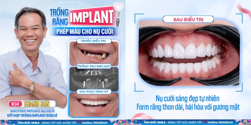 Thực hiện Link Vào Abc8.com Đăng Ký Tặng 88K trong phòng vô trùng tuyệt đối giúp hạn chế biến chứng và đảm bảo an toàn tối đa cho bệnh nhân