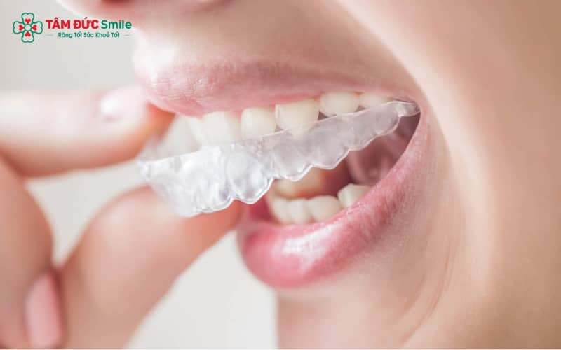 Invisalign phù hợp với răng lệch nhẹ đến trung bình