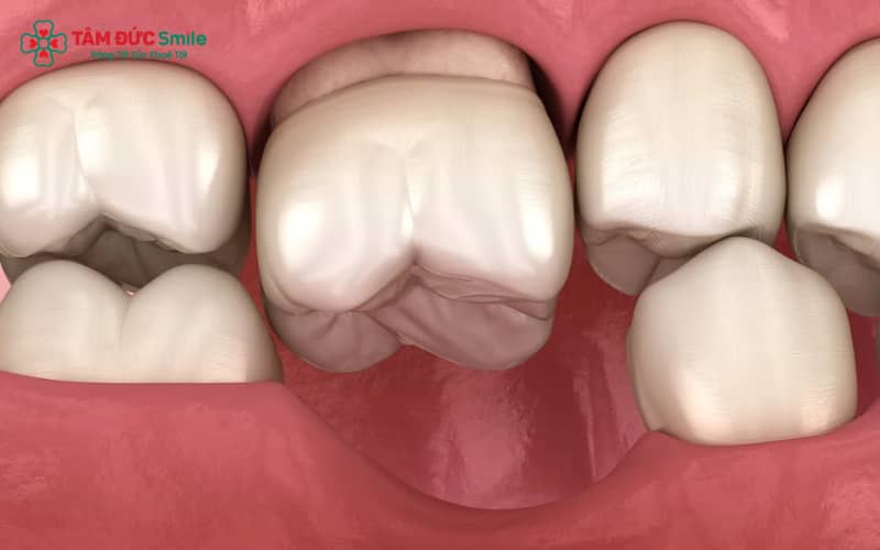 Các nguyên tắc Kennedy gồm xác định khoảng mất răng chính, phân loại các khoảng bổ sung và loại trừ vùng không được tính, đảm bảo chẩn đoán nhất quán