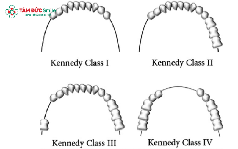 Hình mô phỏng trực quan 4 nhóm Kennedy