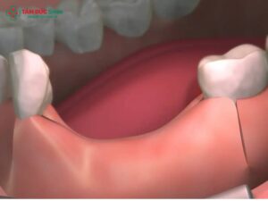 Phân loại mất răng theo Kennedy: Class I–IV, mất răng từng phần, khung hàm tháo lắp