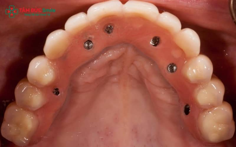Mô phỏng cấu tạo và cơ chế hoạt động của phục hình bắt vít trên Implant – giúp gắn chặt mão sứ với trụ implant bằng vít chuyên dụng