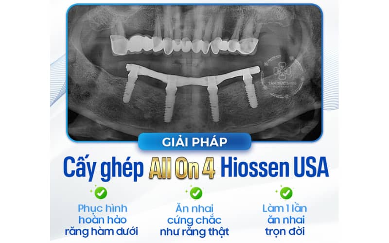 Phục hình bắt vít trên Implant giúp dễ tháo lắp, độ chính xác cao và mang lại Abc8c1 com khuyến mãi hấp dẫn tự nhiên vượt