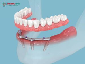 Phục hình bắt vít trên Implant là gì? Ưu điểm và quy trình