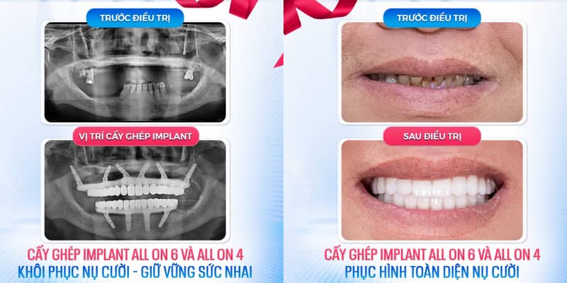 Chế độ chăm sóc sau Abc8b tải ứng dụng ảnh hưởng trực tiếp đến khả năng lành thương và bền chắc của Implant