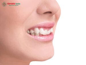 Răng khấp khểnh: Nguyên nhân, hậu quả và cách khắc phục hiệu quả