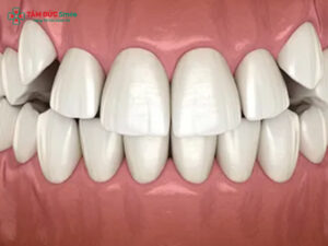 Răng khểnh đẹp – Duyên dáng, phong thủy và Abc8c1 com khuyến mãi hấp dẫn hiện đại