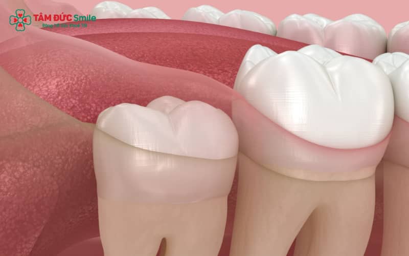 Răng khôn mọc thẳng là răng hàm số 8 mọc đúng hướng, không nghiêng hoặc lệch, không chèn ép các răng khác.