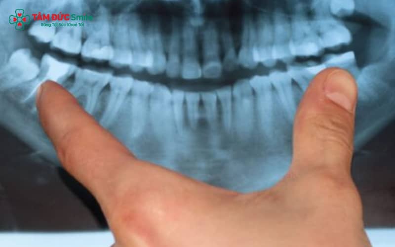 Răng khôn mọc thẳng và không gây triệu chứng thường không cần nhổ