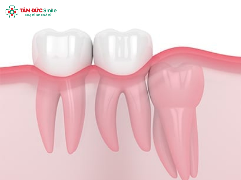 Răng khôn mọc thẳng có nên nhổ không? Dấu hiệu và cách chăm sóc