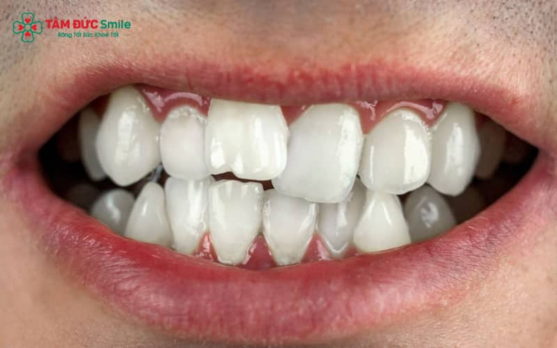 Răng lệch nhẹ, thưa hoặc không đều vừa phải có thể dán sứ veneer để cải thiện Abc8c1 com khuyến mãi hấp dẫn mà không cần niềng