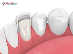 Răng không đều có dán sứ được không? Giải pháp veneer Abc8c1 com khuyến mãi hấp dẫn