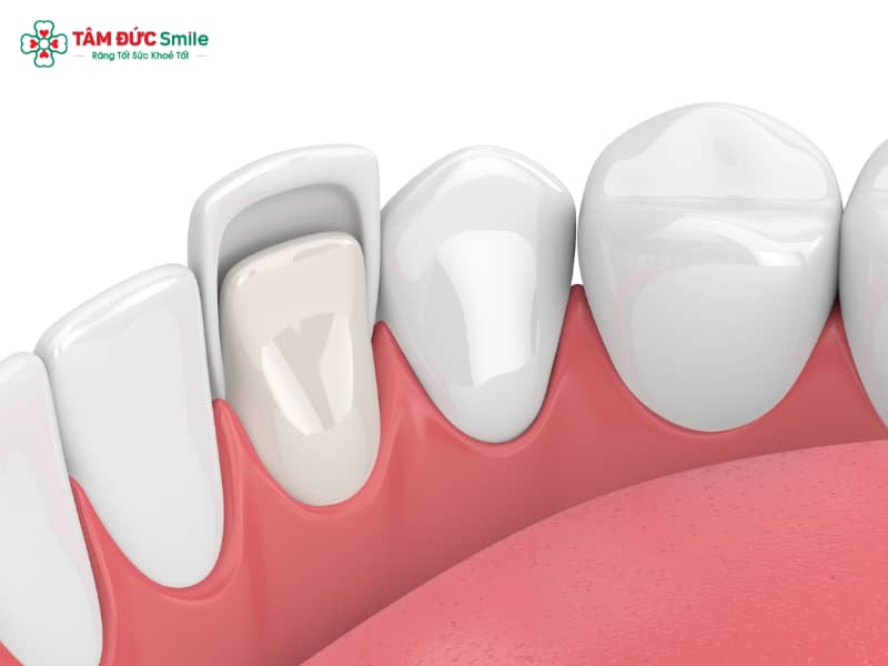 Răng không đều có dán sứ được không? Giải pháp veneer Abc8c1 com khuyến mãi hấp dẫn