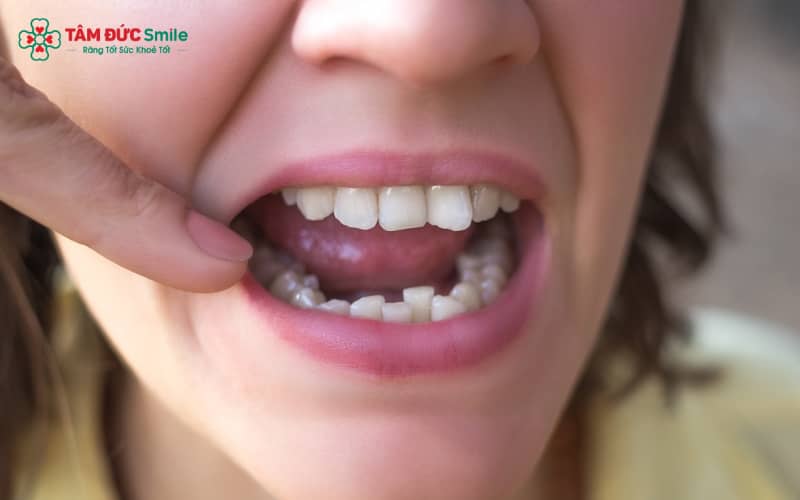 Răng mọc lệch hoàn toàn có thể bọc sứ nếu tình trạng lệch nhẹ đến vừa