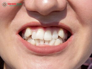 Răng mọc lệch có bọc sứ được không?Giải pháp Abc8c1 com khuyến mãi hấp dẫn nhanh
