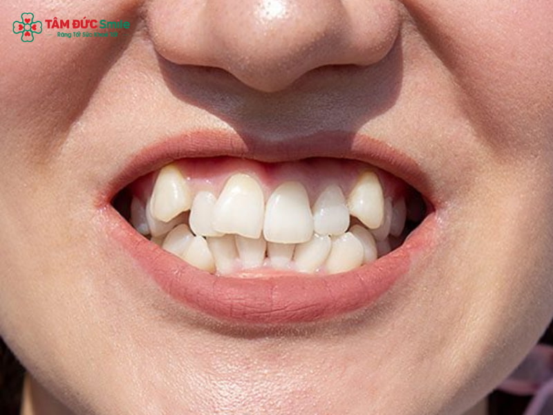 Răng mọc lệch có bọc sứ được không?Giải pháp Abc8c1 com khuyến mãi hấp dẫn nhanh