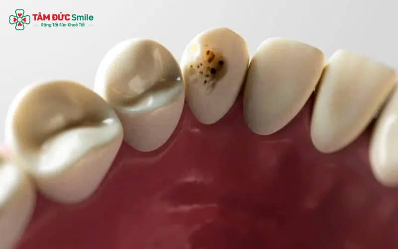 Răng sâu có thể xuất hiện vết đen, đau nhẹ hoặc ê buốt khi ăn uống – cần phát hiện sớm để tránh lan rộng