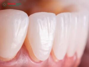 Răng sâu có dán sứ được không? Giải pháp phục hình Abc8c1 com khuyến mãi hấp dẫn hiệu quả