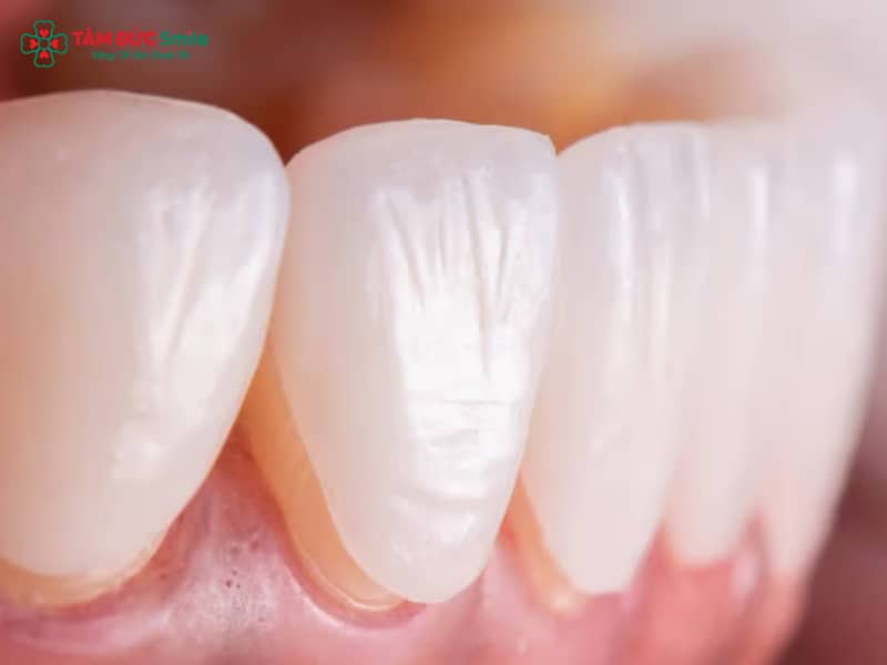 Răng sâu có dán sứ được không? Giải pháp phục hình Abc8c1 com khuyến mãi hấp dẫn hiệu quả